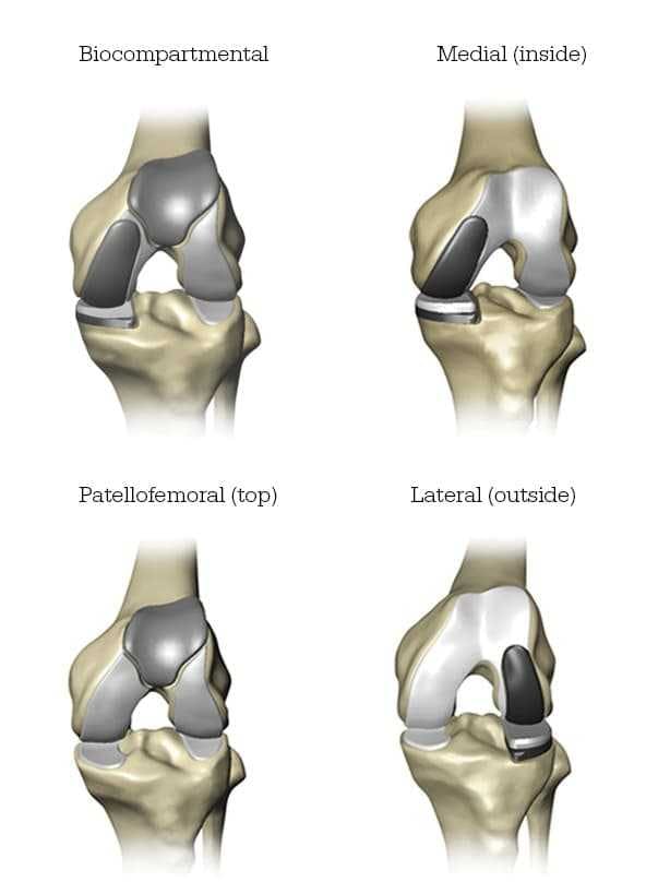 This image shows the bicompartmental, the medial (inside), the patellofemoral (top, and the lateral (outside) parts of the knee.