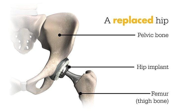 This image shows a replaced hip where the pelvic bone connects to the hip implant and that connects to the femur (thigh bone)