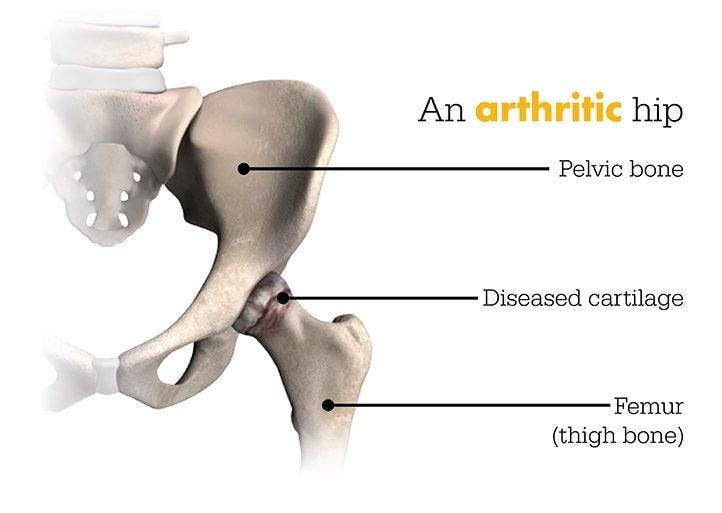 This image shows an arthritic hip where the pelvic bone connects to the diseased cartilage and that connects to the femur (thigh bone)