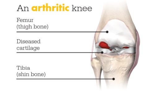 This image shows an arthritic knee where the femur (thigh bone) connects to the diseased cartilage and that connects to the tibia (shin bone)