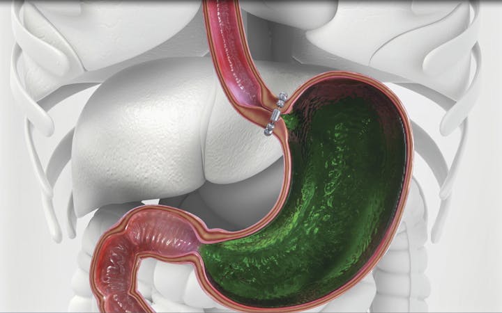 An image shows how the LINX device works.